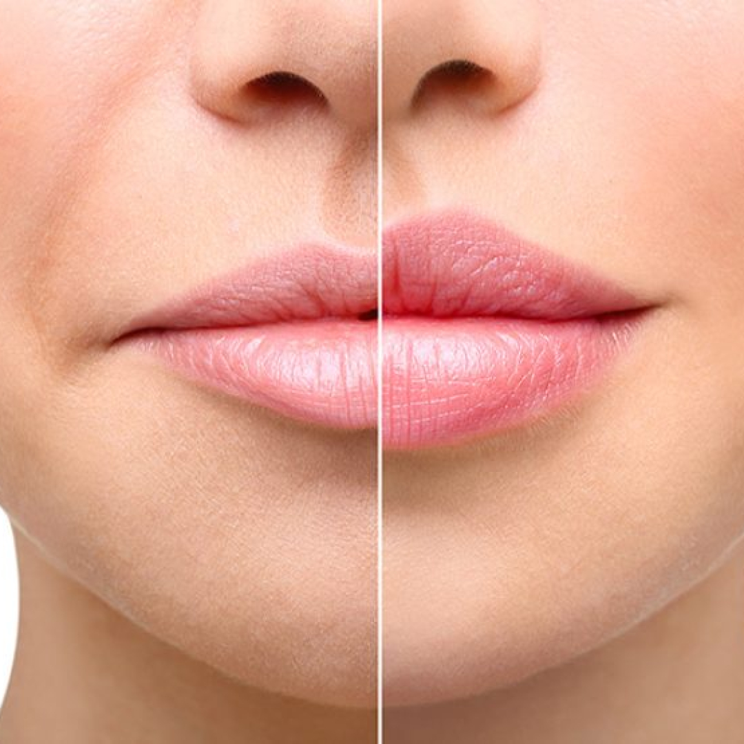Dermal-Fillers-Lacurra-Med-Spa-q98sdb1vjnkha5l0b92ega5wlhn1cc5bkgex6nti26