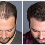Ryan-before-after-1-300x178