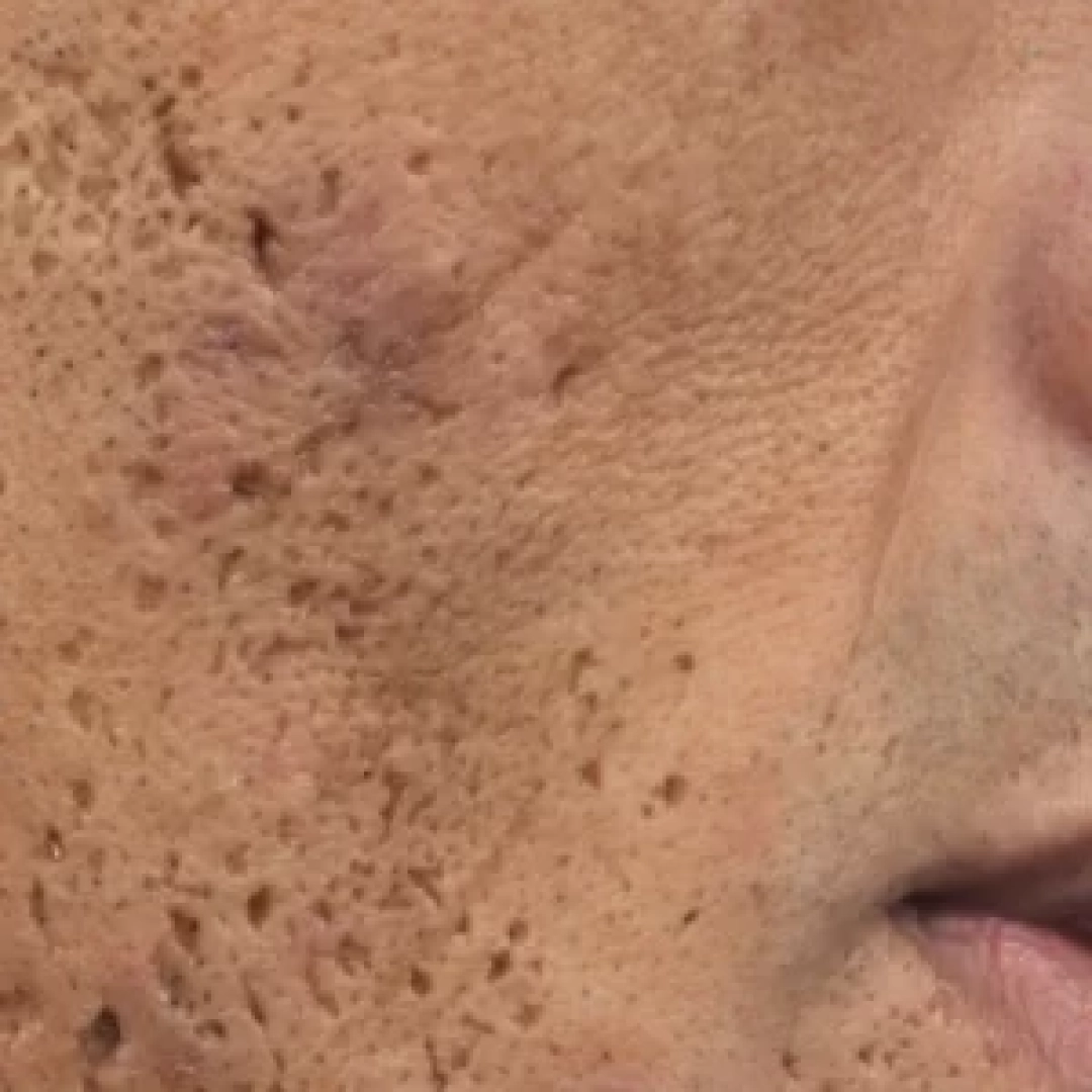 acne-scar-300x300