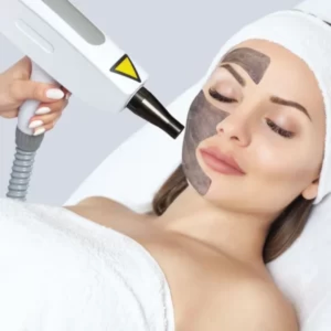 carbon-peel-treatment-300x300