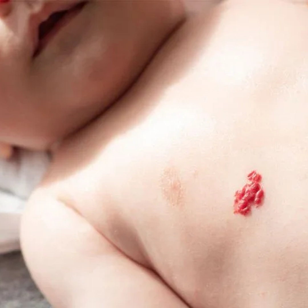 hemangiomas_treatment