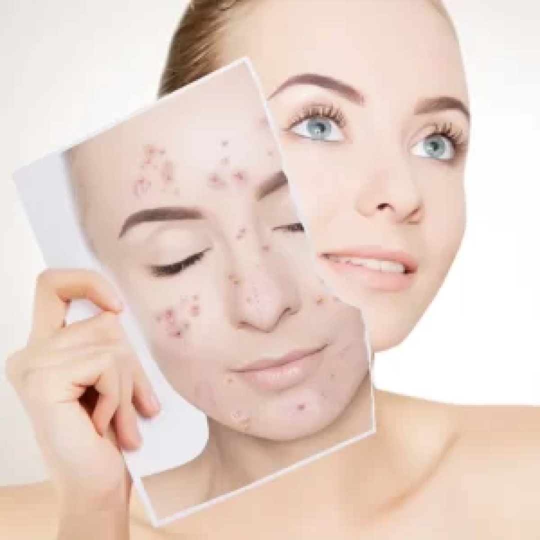 laser-acne-300x300