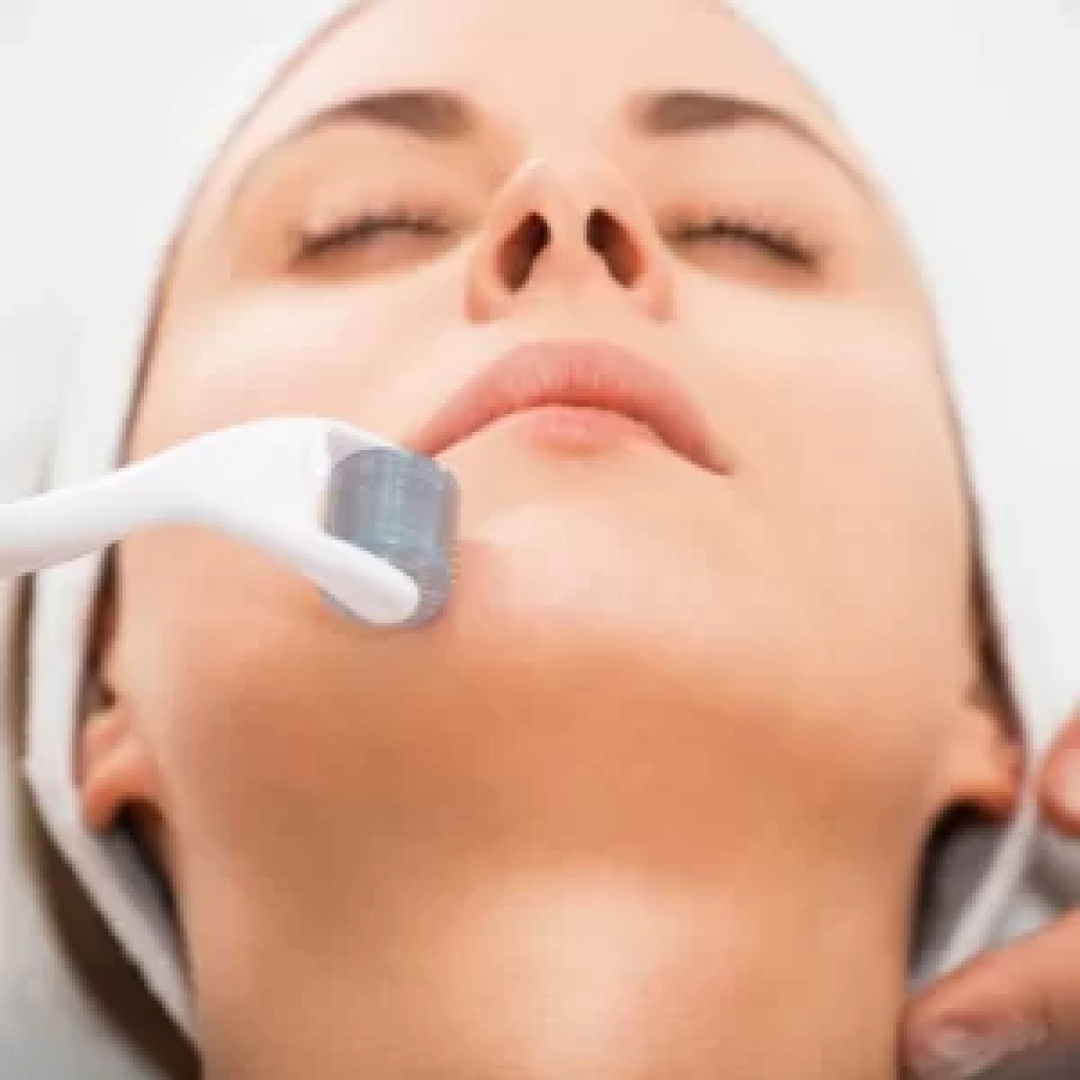 micro-needling-300x300