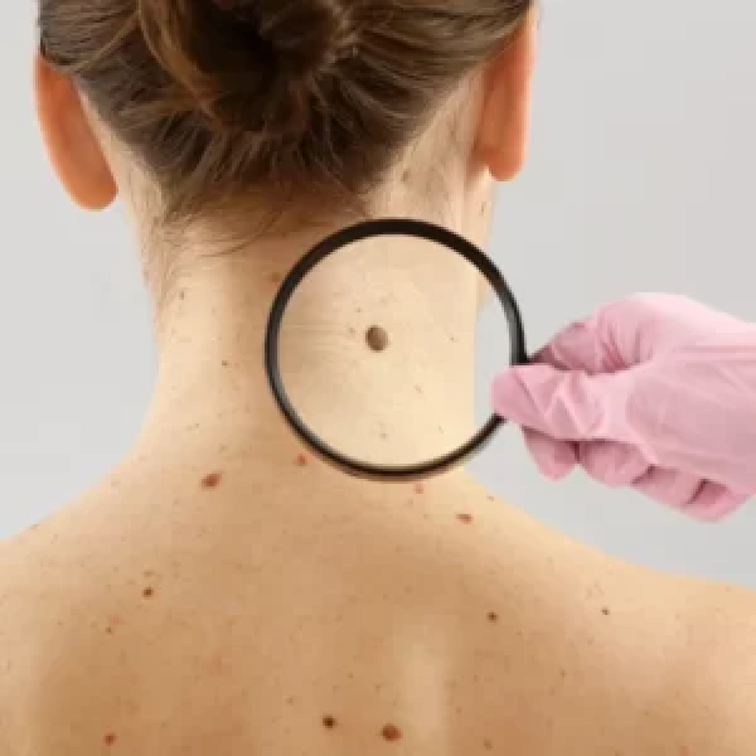 moles-removal-300x300