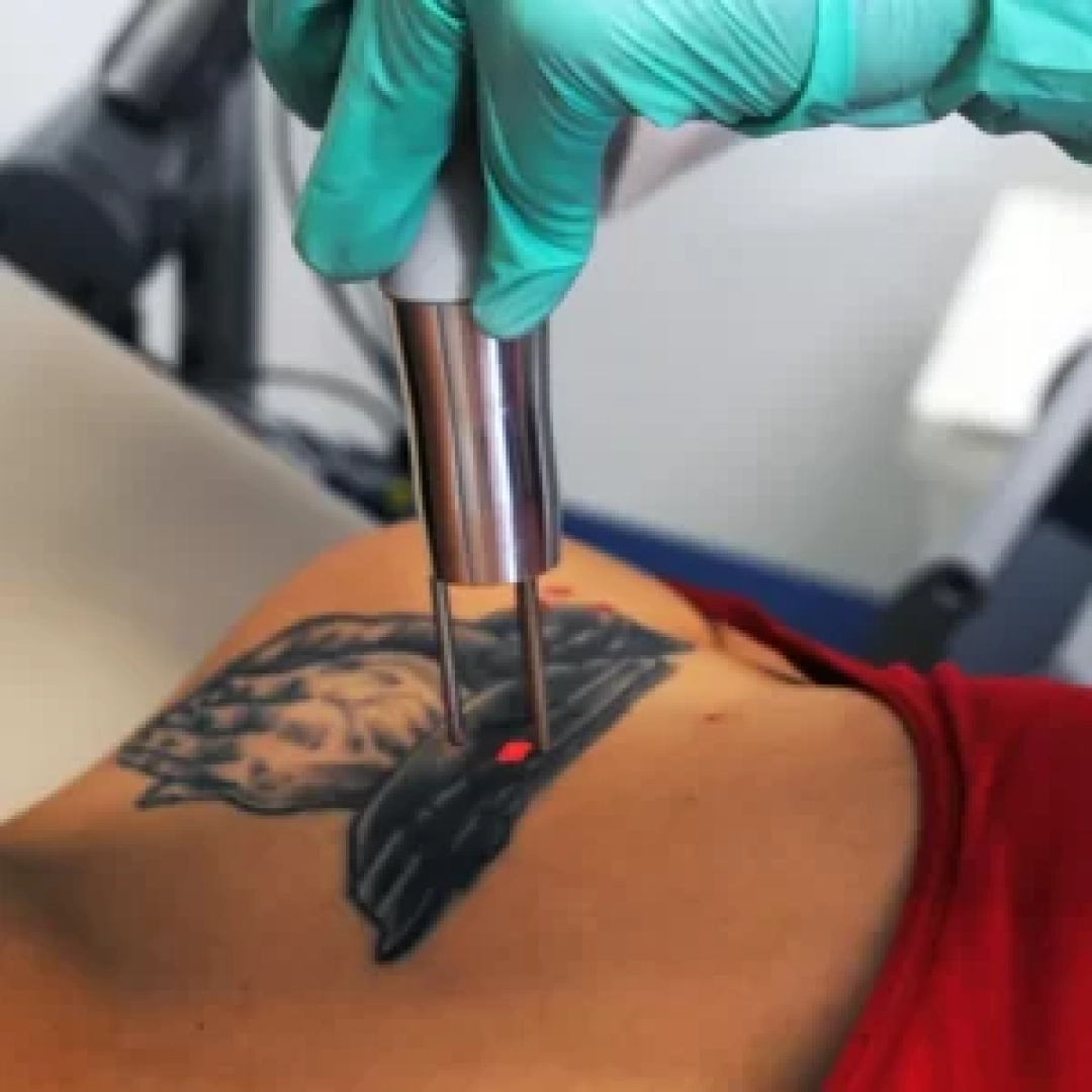 tattoo-removal-300x300