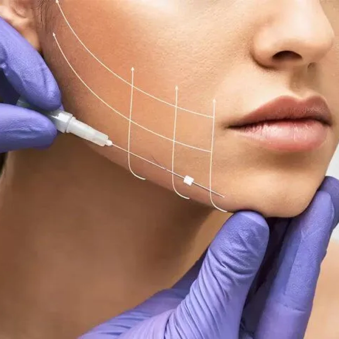 thread_lifts
